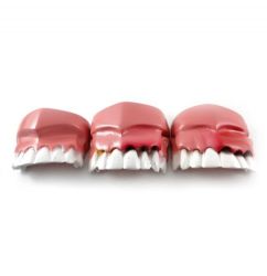 Evolução da doença periodontal - Odontomar